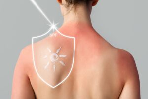 Alergija na sunce, sve što treba da znate